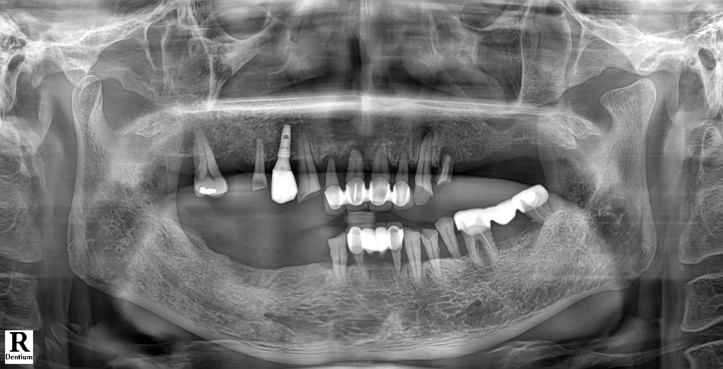 IMPLANT CASE 파노라마 Before